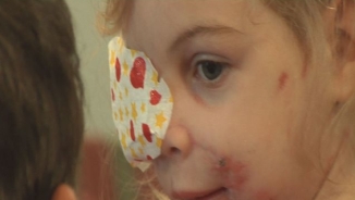 Report: Little Girl Kicked Out of KFC for Scarred Face a Hoax, Fabricated by Family for Money